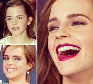 Emma Watson Teeth Before and After
