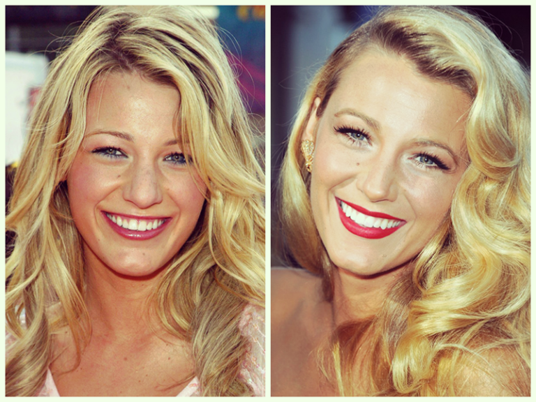 Blake Lively Before and After Braces | Hoyt Dental | Murrieta ...