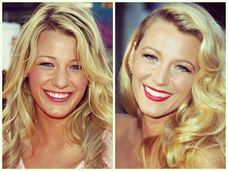 Blake Lively Before and After Braces