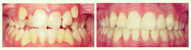 Braces Before and After 2