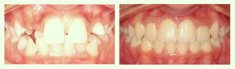 Braces Before and After 3