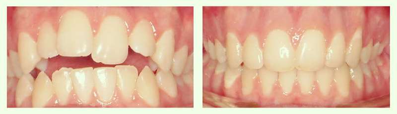 Braces Before and After 4