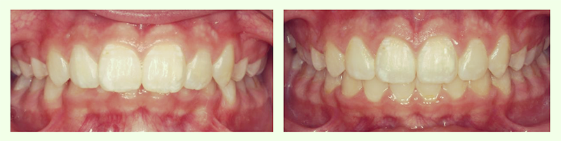 Braces Before and After 5