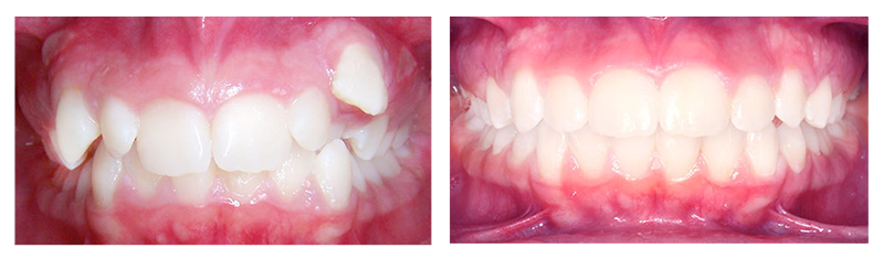 Braces Before and After