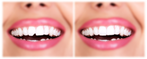 Chipped Tooth Before After Bonding