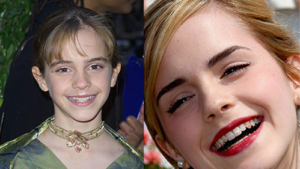 Emma Watson Before and After Braces
