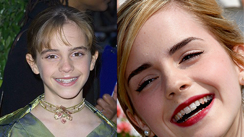 Emma Watson Before and After Braces