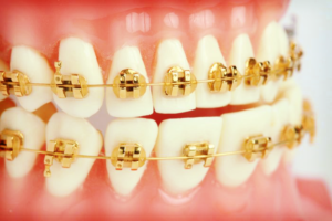 Gold Braces