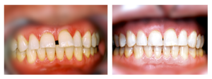 Teeth Gap Before After Bonding
