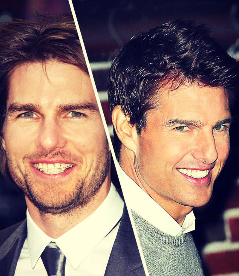 Tom Cruise Before and After Braces