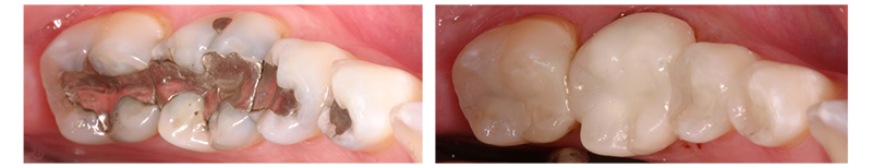 Tooth Colored Fillings Before After