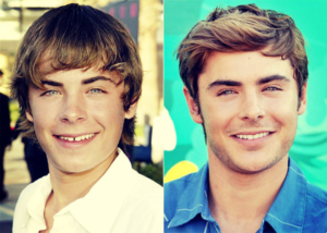 Zac Efron Before and After Braces