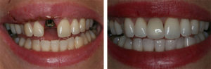 Dental implant