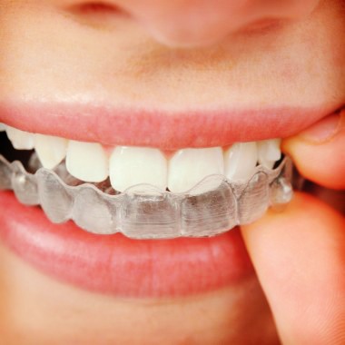 Invisalign