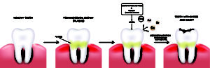 Tooth decay formation